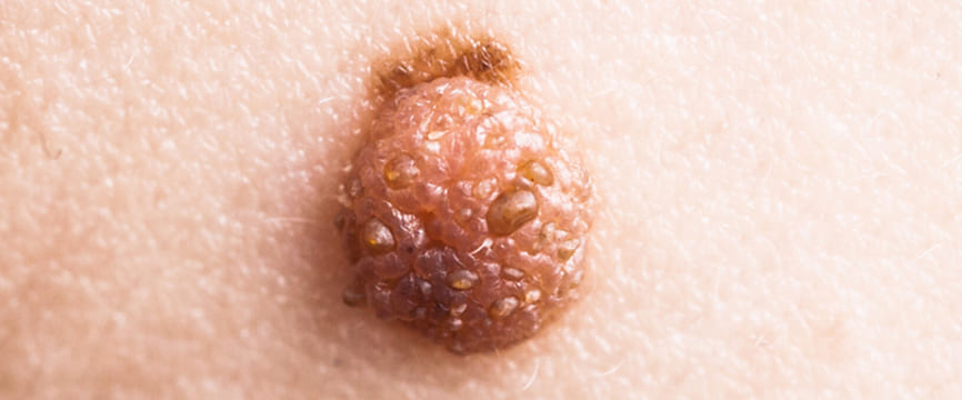 軟性繊維腫│非ウイルス性