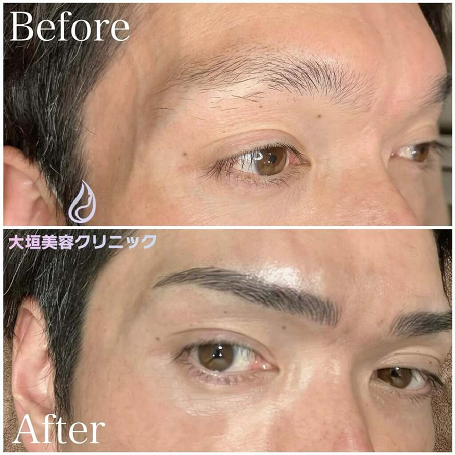 医療アートメイク(眉毛)