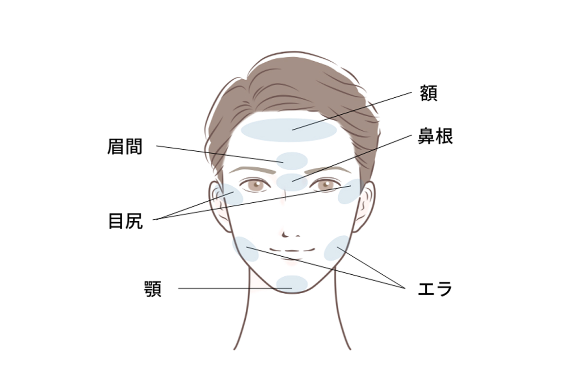 ボトックス施術部位