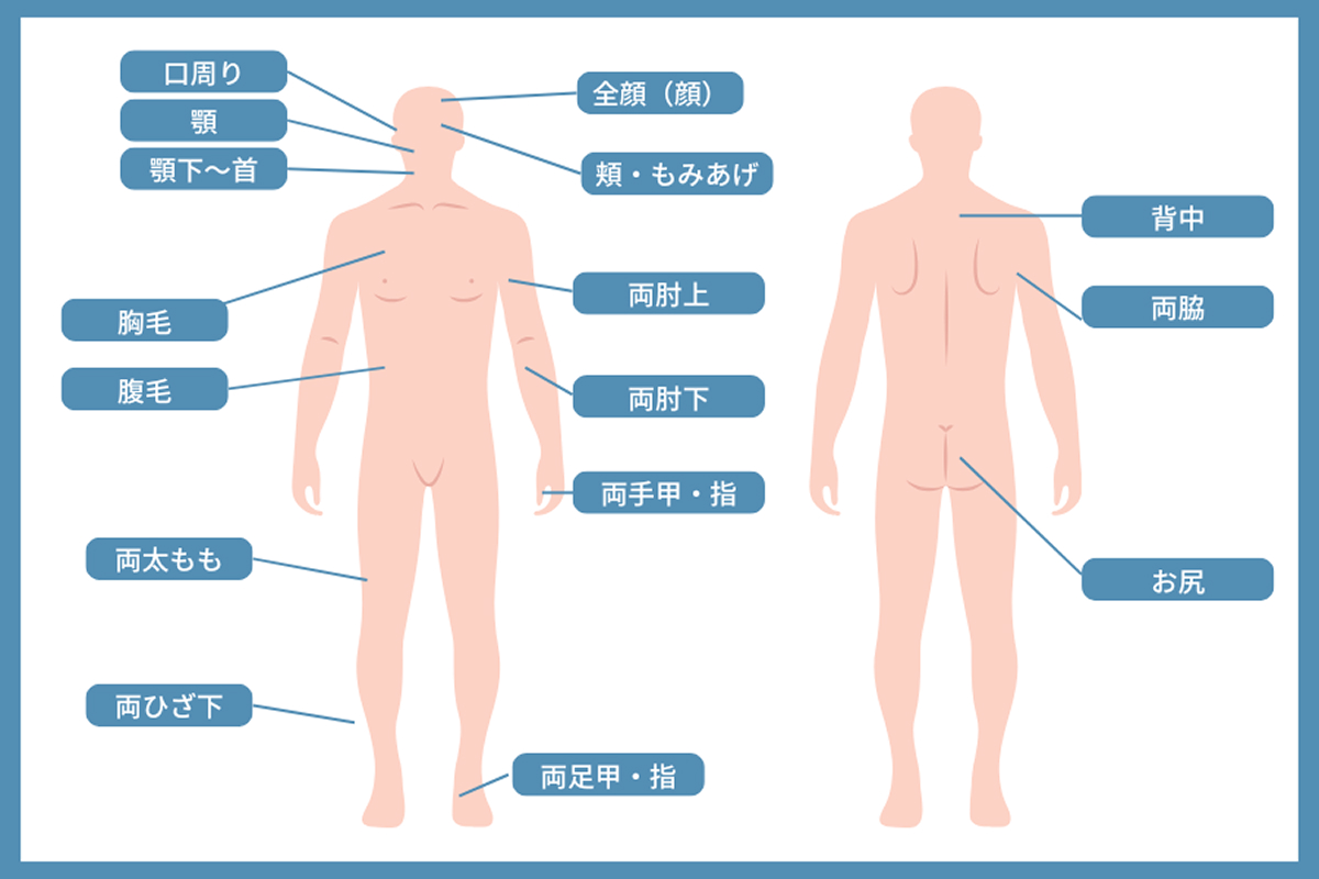 医療脱毛(男性)部位