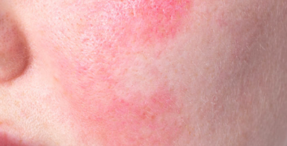 ニキビ、乾燥、皮膚炎などの肌トラブル