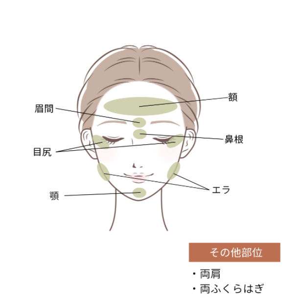 ボトックス