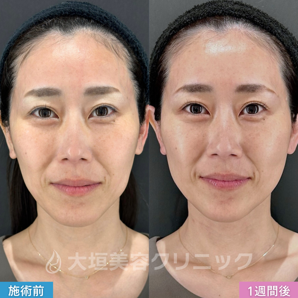 糸リフト（アルテミスリフト6本）