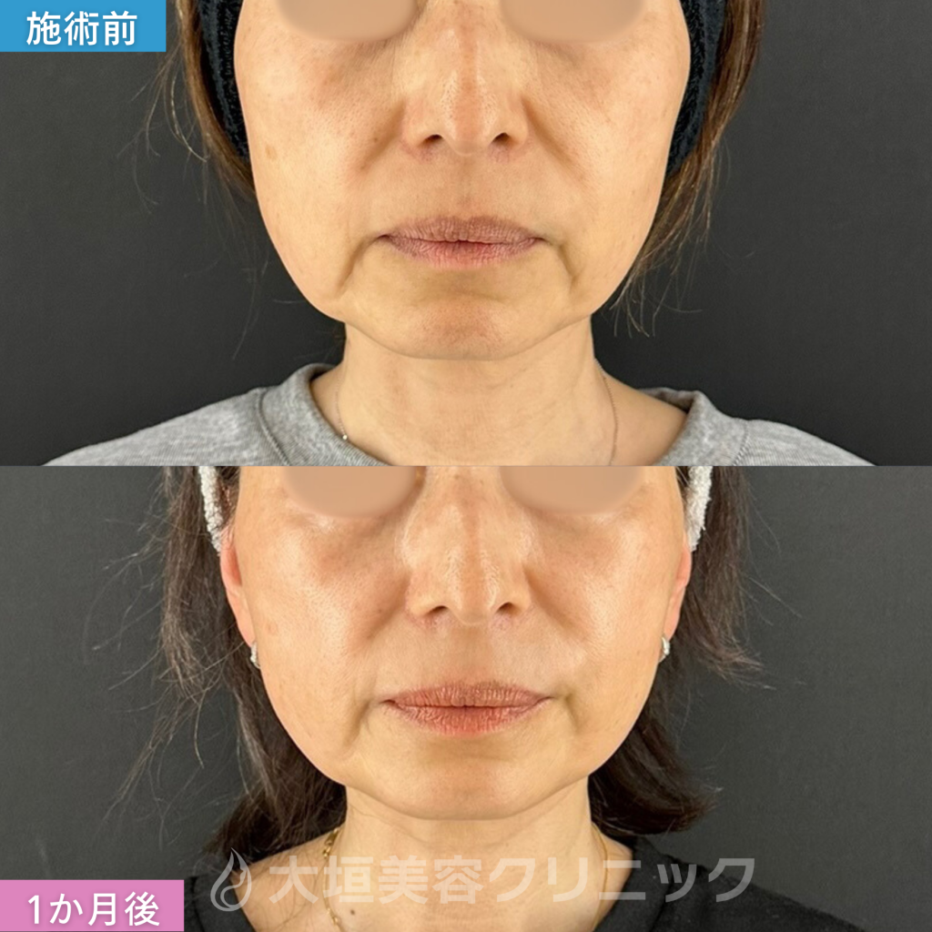 糸リフト（アルテミスリフト6本）