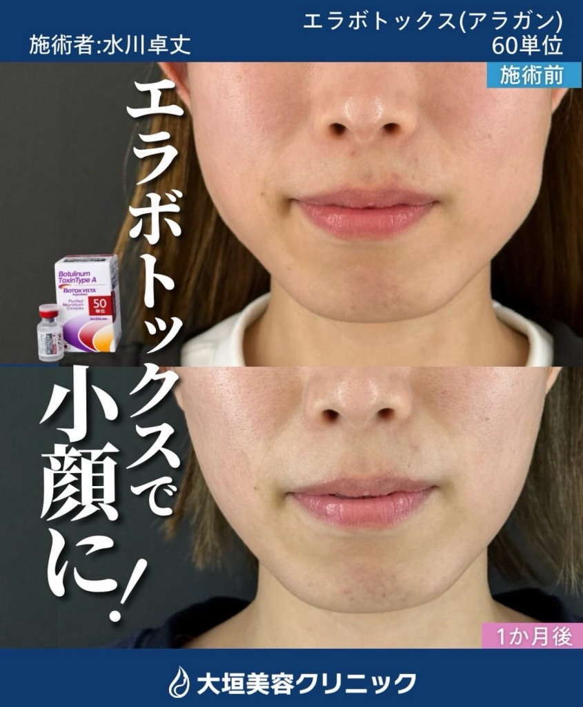 ボトックス