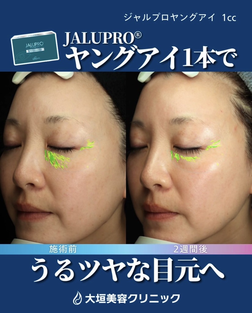 ジャルプロヤングアイ