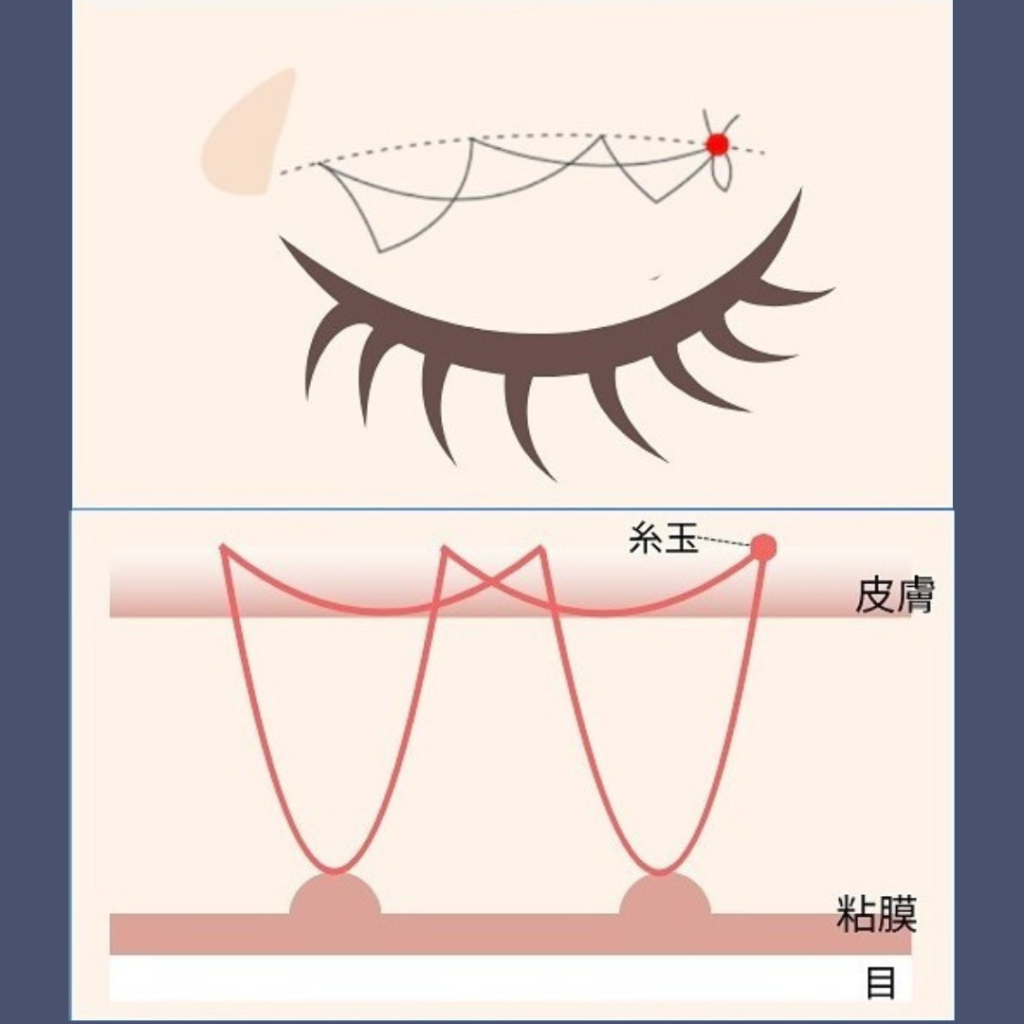 自然癒着法（二重埋没法）