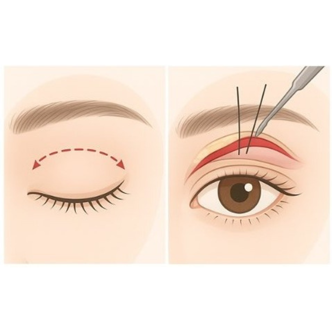 眼瞼下垂切開法｜大垣美容クリニック