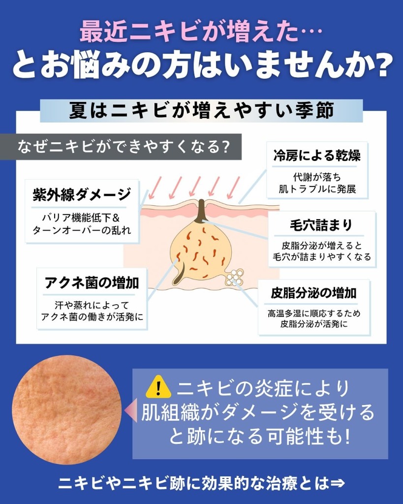 岐阜・大垣美容クリニックの美容皮膚科スタッフが教えるニキビ治療の選び方と治療別メリット
