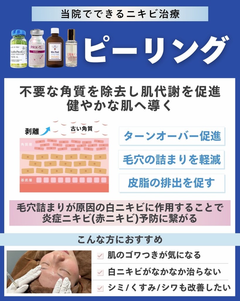 岐阜・大垣美容クリニックの美容皮膚科スタッフが教えるニキビ治療の選び方と治療別メリット