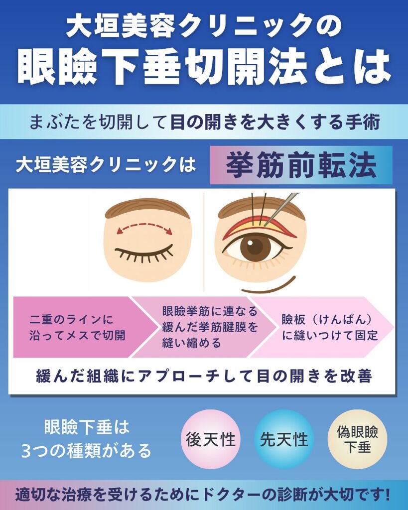 眼瞼下垂切開法　【岐阜で眼瞼下垂の名医を探している方へ】まぶたの悩みに寄り添う“丁寧な眼瞼下垂切開法”とは｜大垣美容クリニック