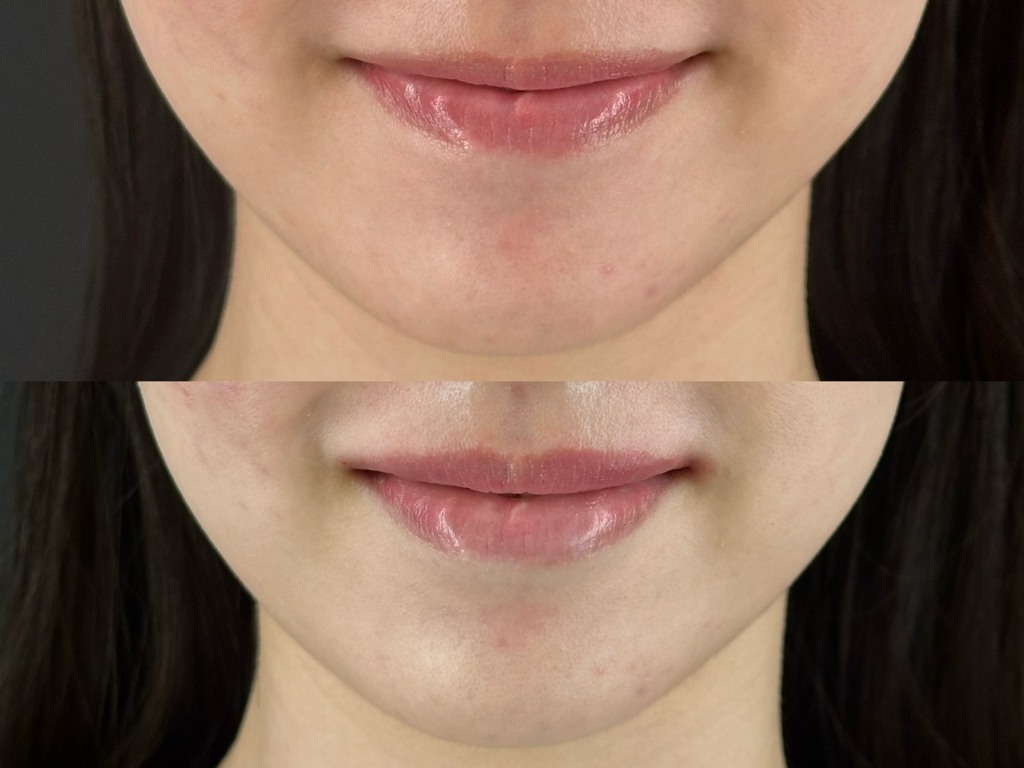 大人気！ヒアルロン酸一本で涙袋も唇も素敵に変身✨