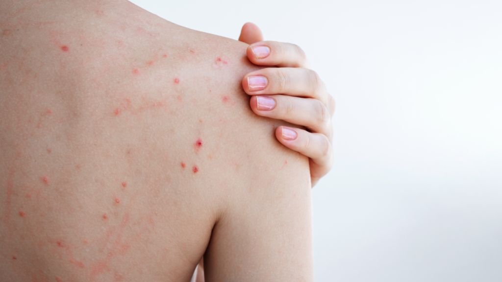 背中　にきび　背中ニキビにお悩みの岐阜の方へ！ニキビの原因からケア方法まで徹底解説