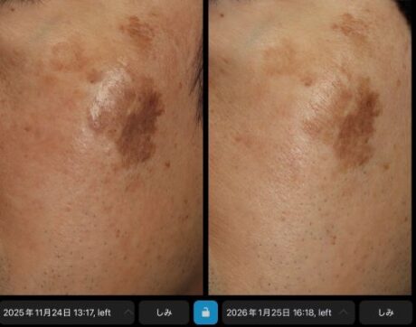 【感動！】男性患者様の劇的変化✨日焼け止め習慣まで…！😭