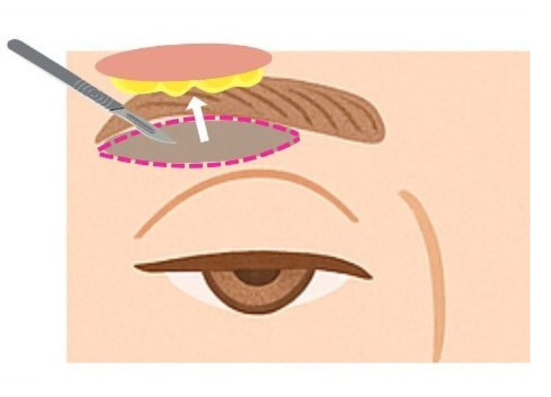 「眉下切開失敗」と後悔しないための信頼できるクリニック選びとは