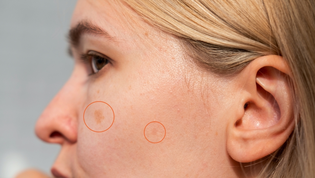 岐阜の美容皮膚科でシミ取りを受けたいと考えている方へ｜理想の肌を目指すための基礎知識