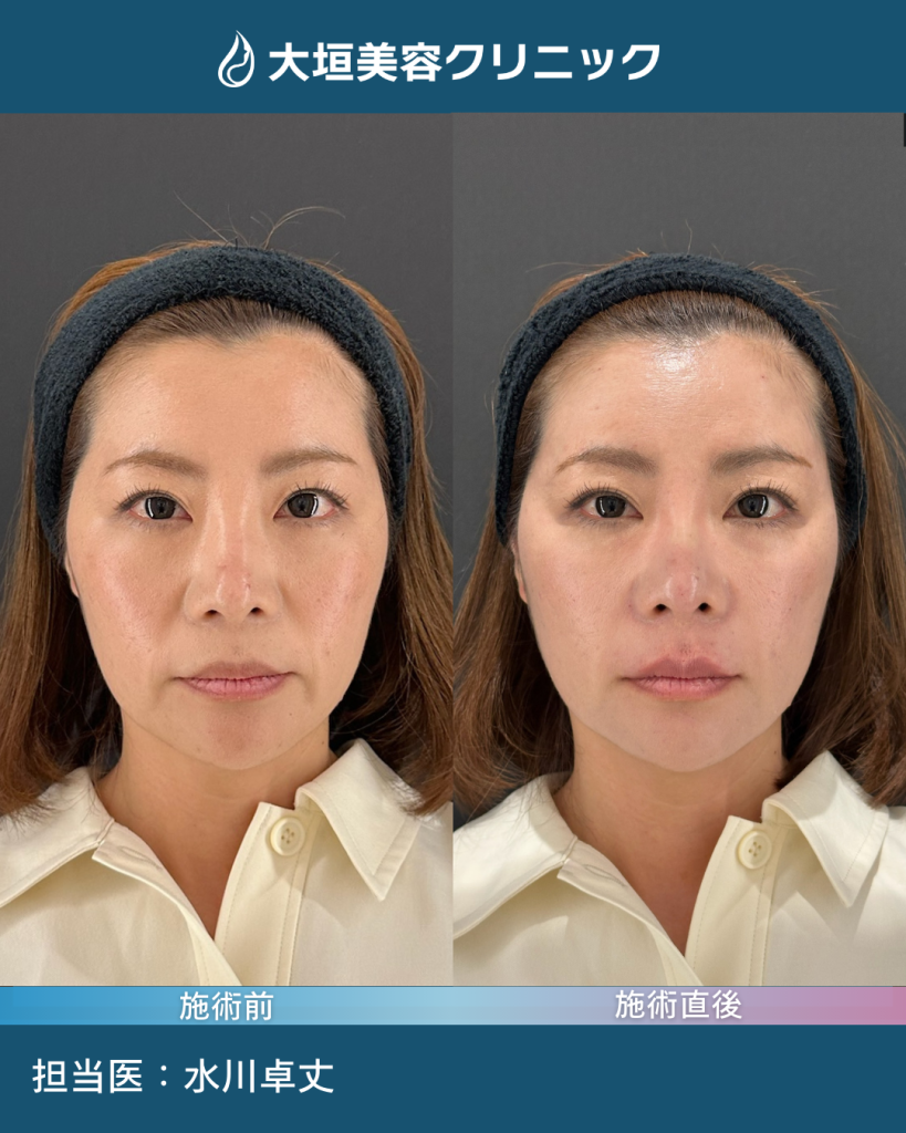 カスタマイズヒアルロン酸②