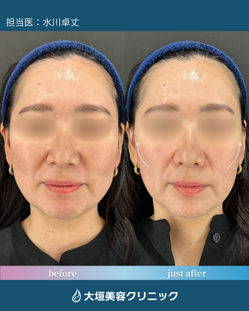 頬 ヒアルロン酸 ①