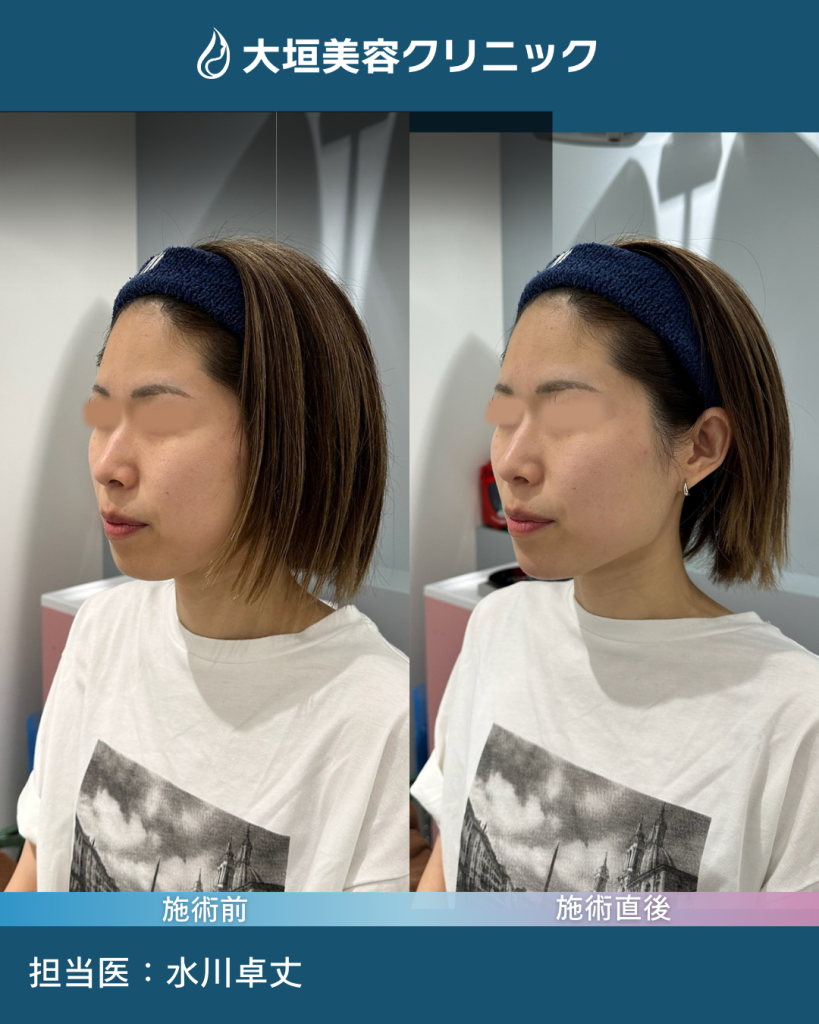 骨上+皮下ヒアルロン酸