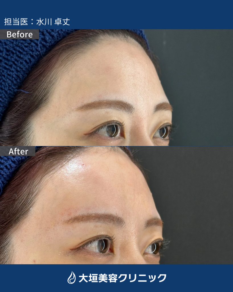 額・こめかみヒアルロン酸②