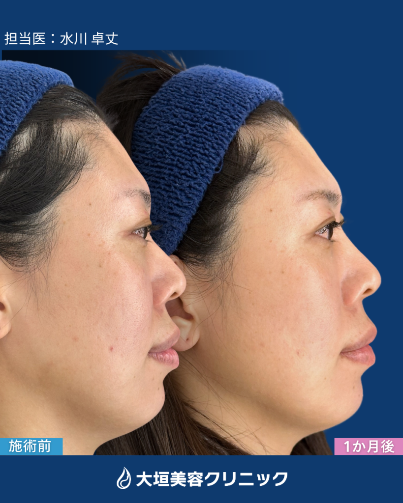 鼻・顎ヒアルロン酸②