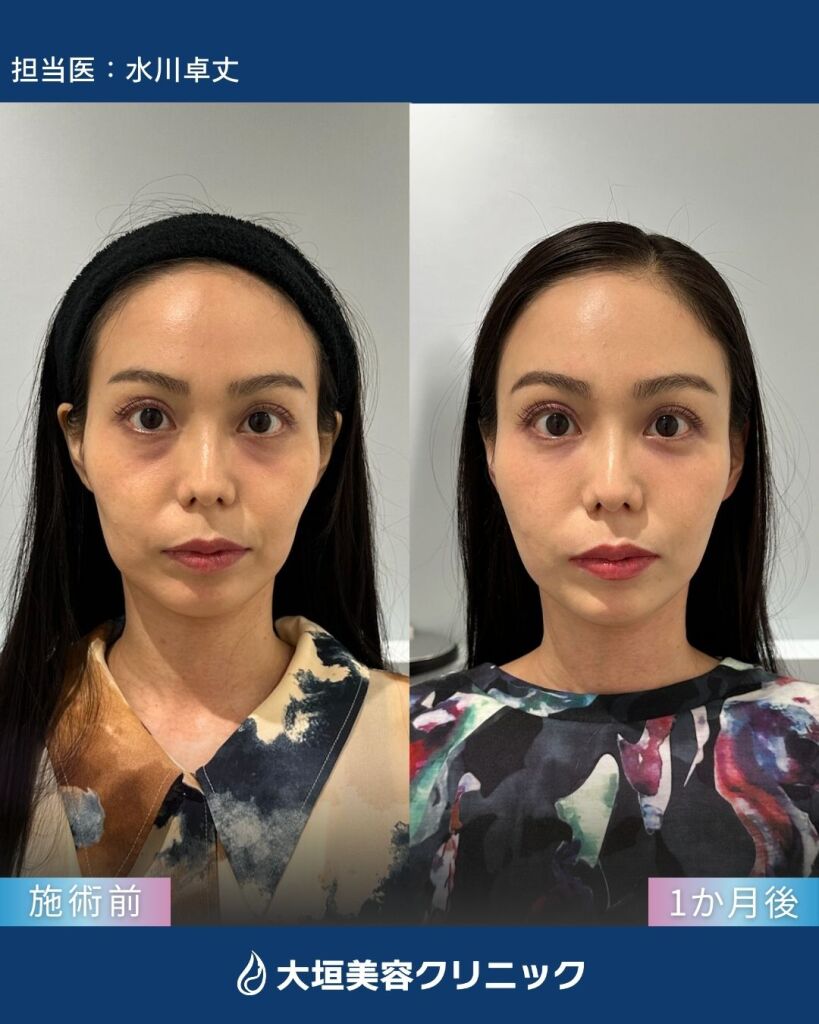 カスタマイズヒアルロン酸③