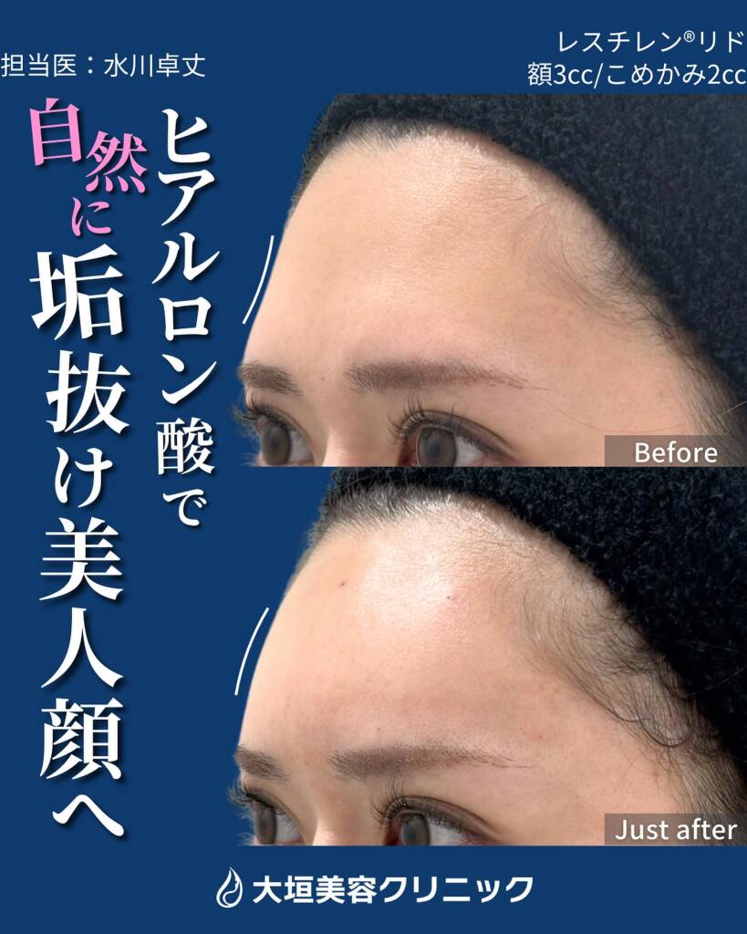 おでこヒアルロン酸で印象は変わる？自然な仕上がりのポイントと注意点 ｜大垣美容クリニック
