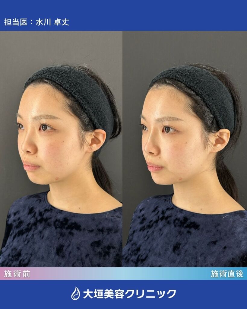 鼻・顎ヒアルロン酸④