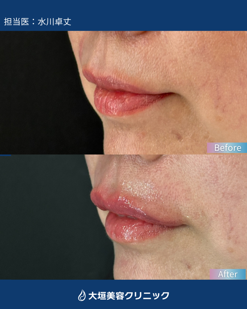 唇ヒアルロン酸②