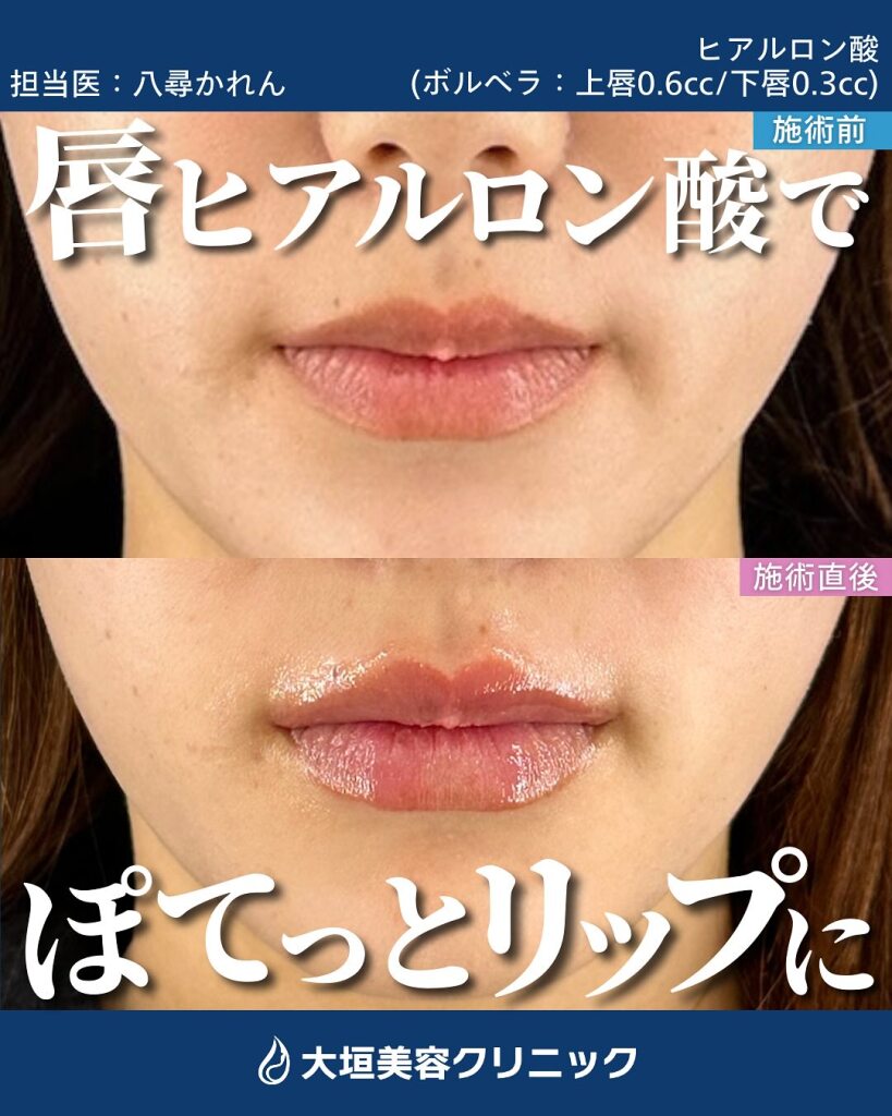 【唇ヒアルロン酸注射が人気】注目される理由や後悔しないためにやりすぎリスクもチェック｜大垣美容クリニック