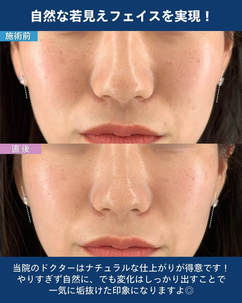 頬こけヒアルロン酸注射でやつれた印象にアプローチ｜後悔しないためのポイントも解説｜大垣美容クリニック