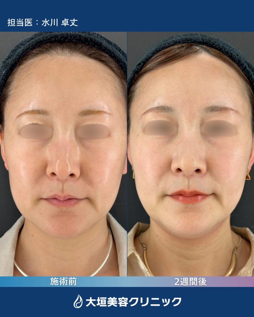 鼻翼基部・頬ヒアルロン酸①