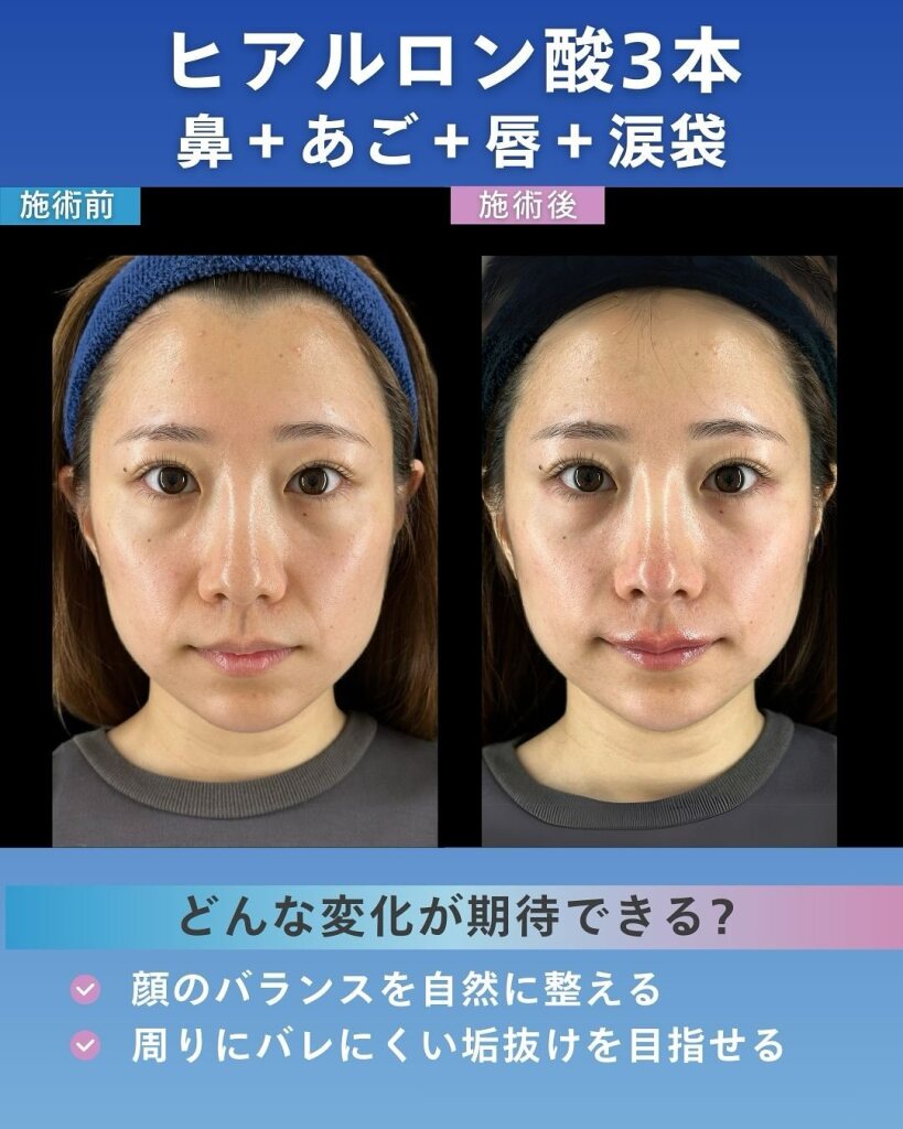 ヒアルロン酸で涙袋形成｜ナチュラルな目元を作るためのポイント｜大垣美容クリニック