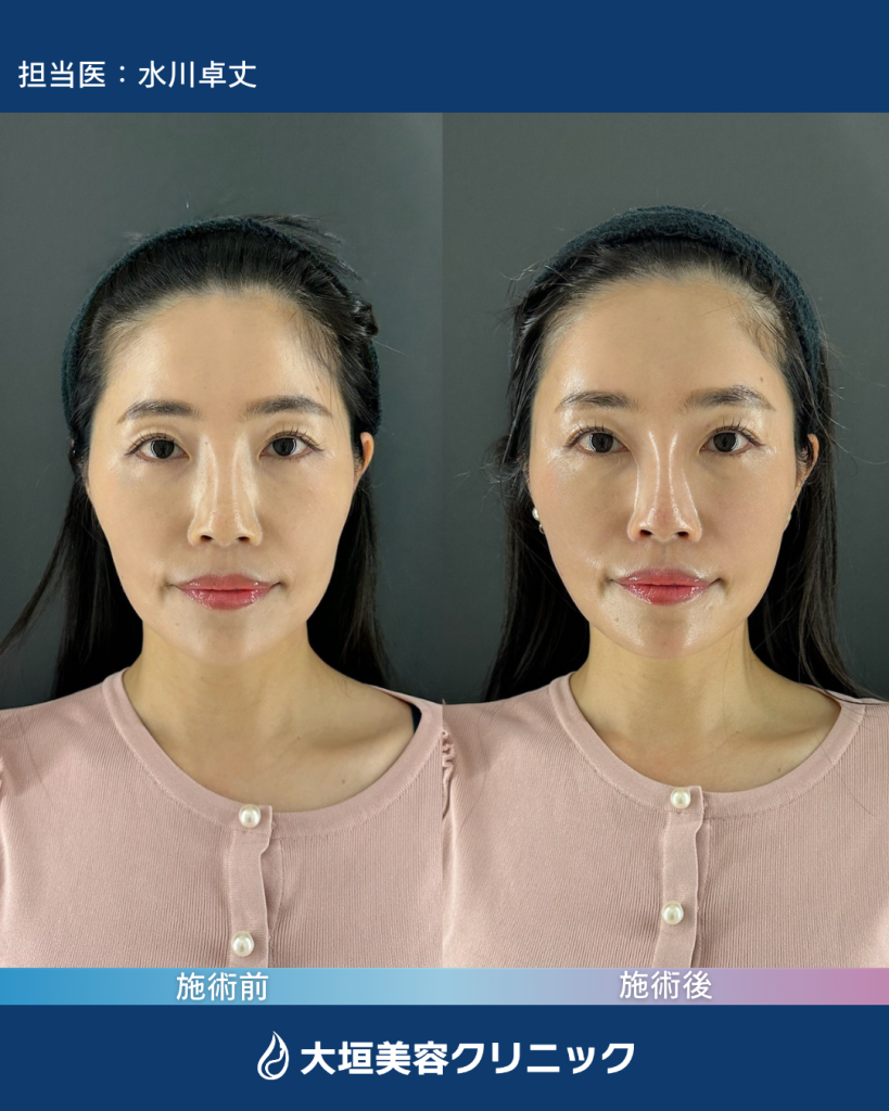 カスタマイズヒアルロン酸①