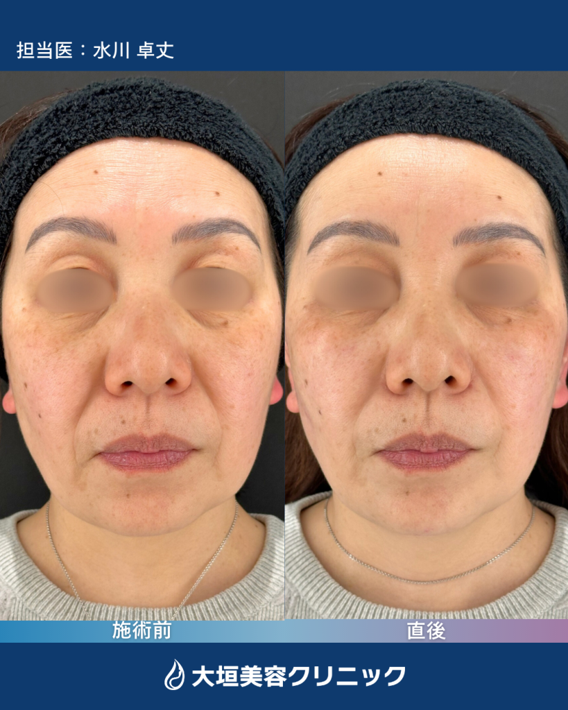 リフトアップヒアルロン酸①