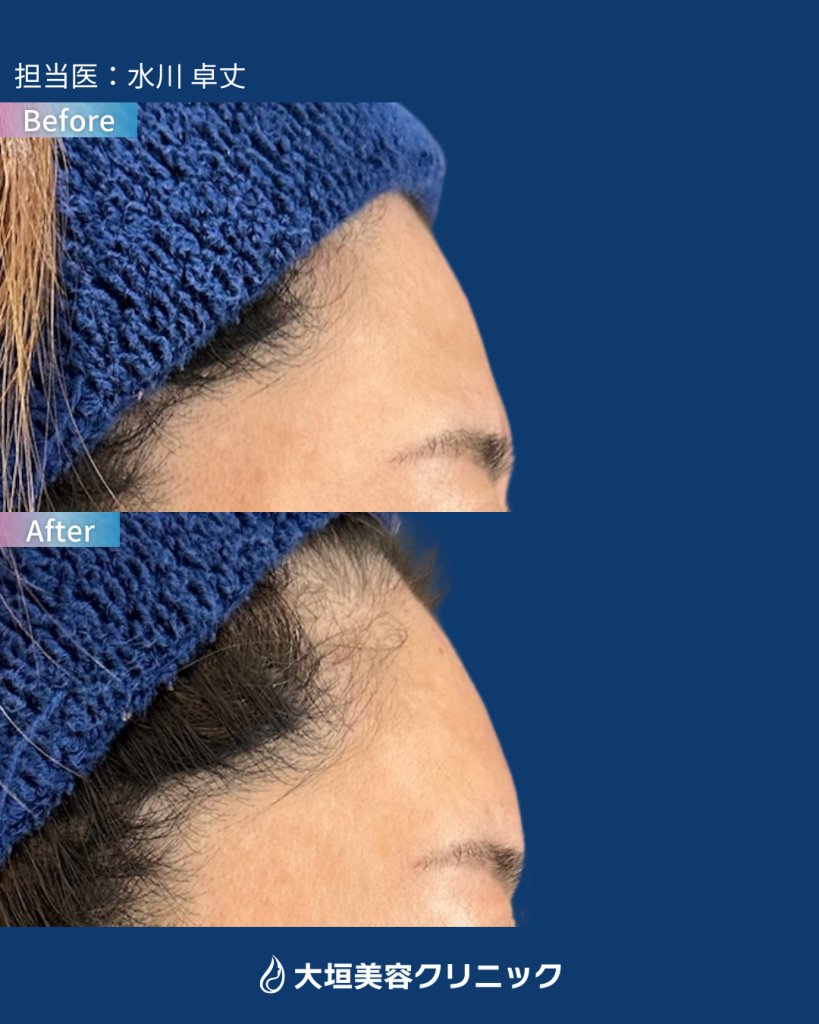 おでこヒアルロン酸②