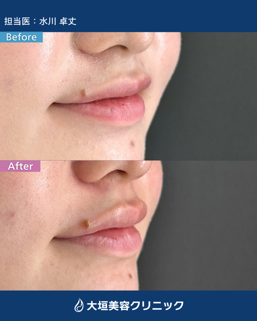 唇ヒアルロン酸④