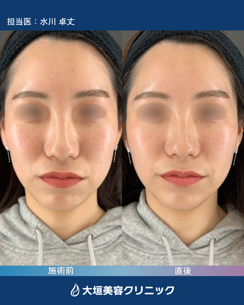 頬ヒアルロン酸②