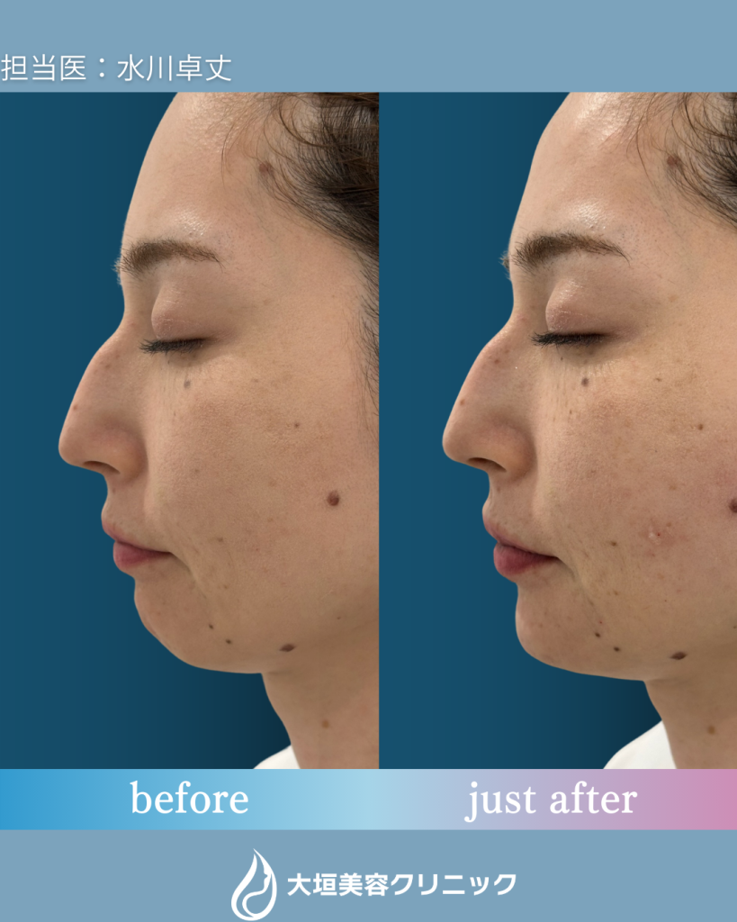 顎ヒアルロン酸