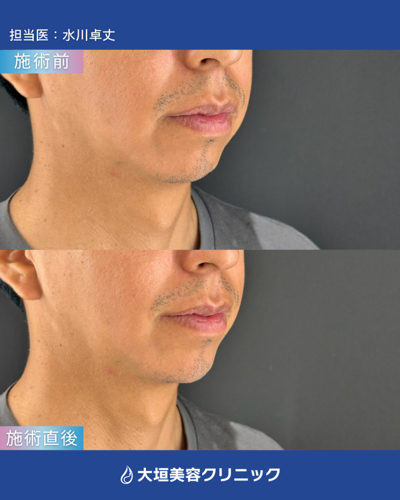 顎ヒアルロン酸②
