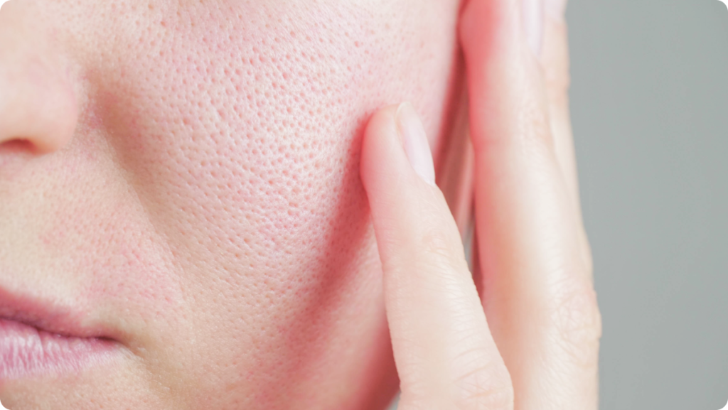 【岐阜で毛穴治療を受けるなら？】皮膚科と美容皮膚科の違いと、自分に合う選び方を解説｜大垣美容クリニック