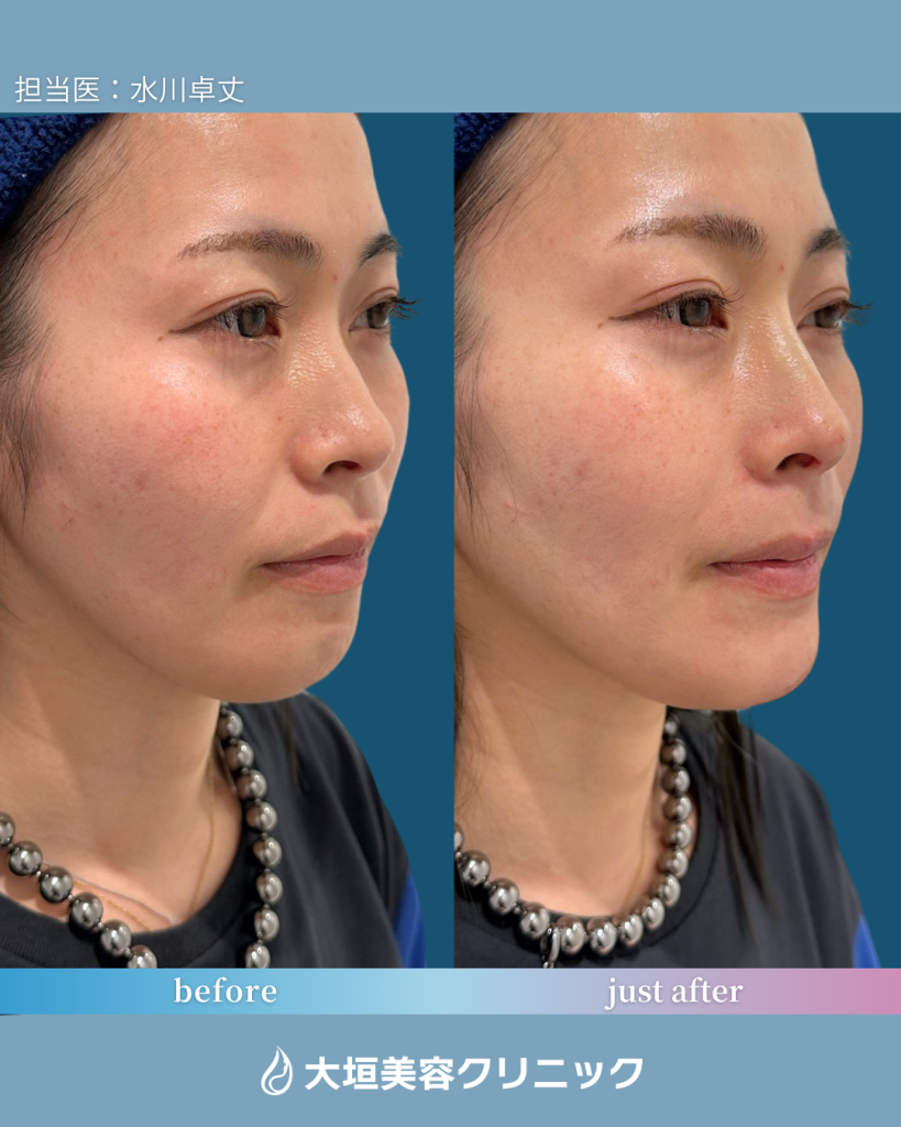 鼻・顎ヒアルロン酸①