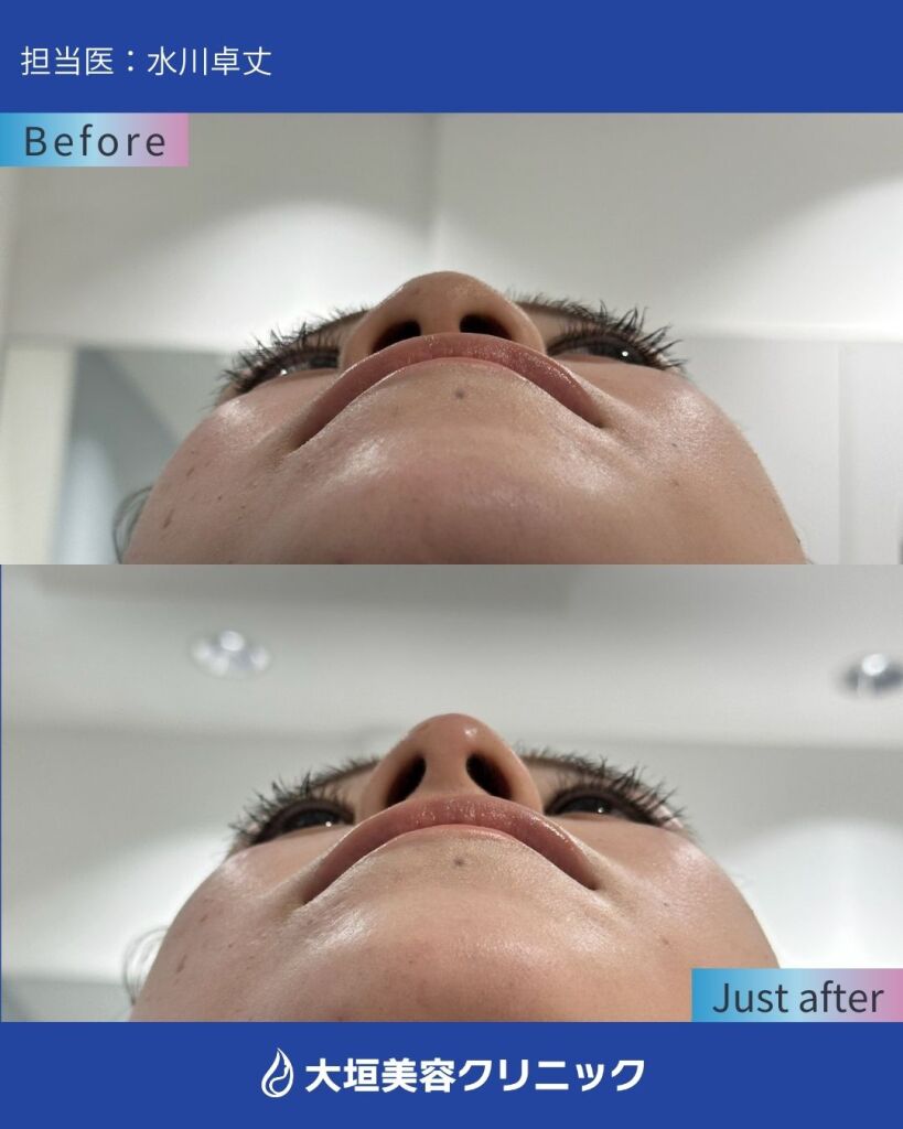 鼻ヒアルロン酸⑤