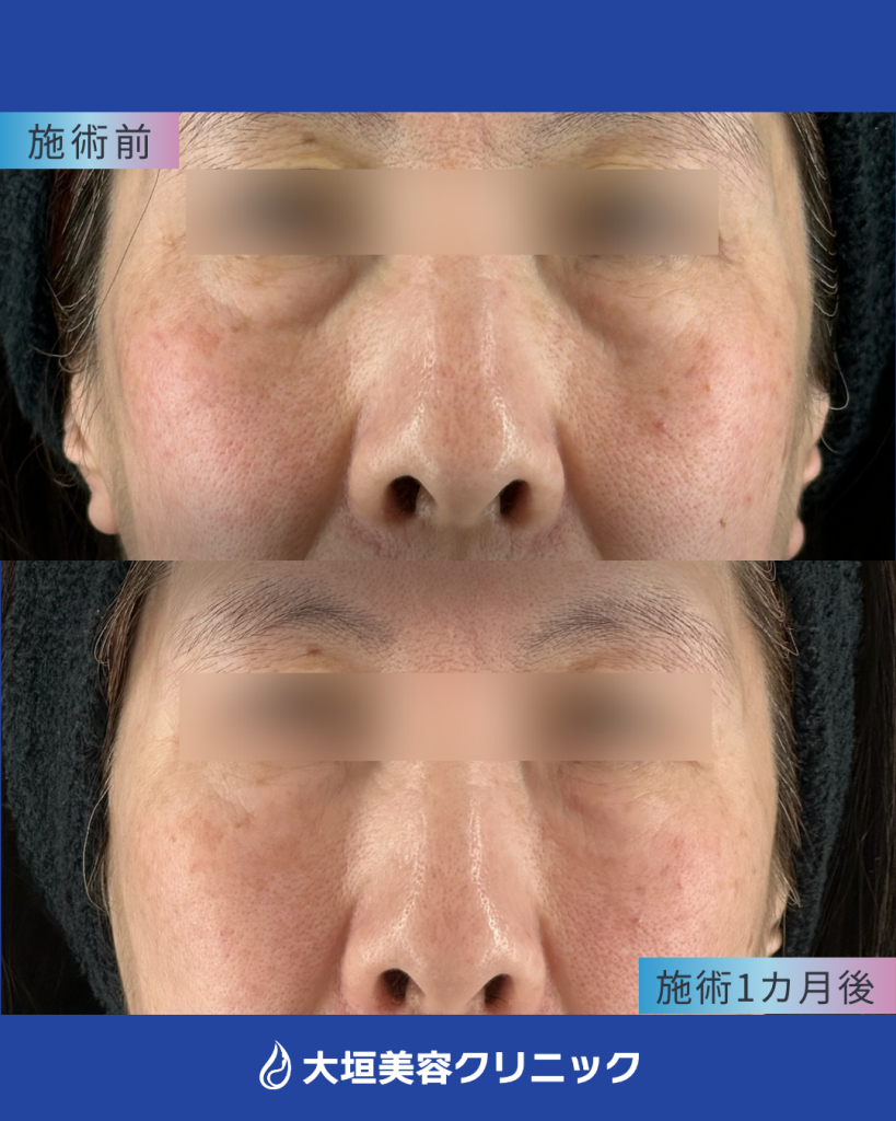 目元ヒアルロン酸＋ベビーコラーゲン