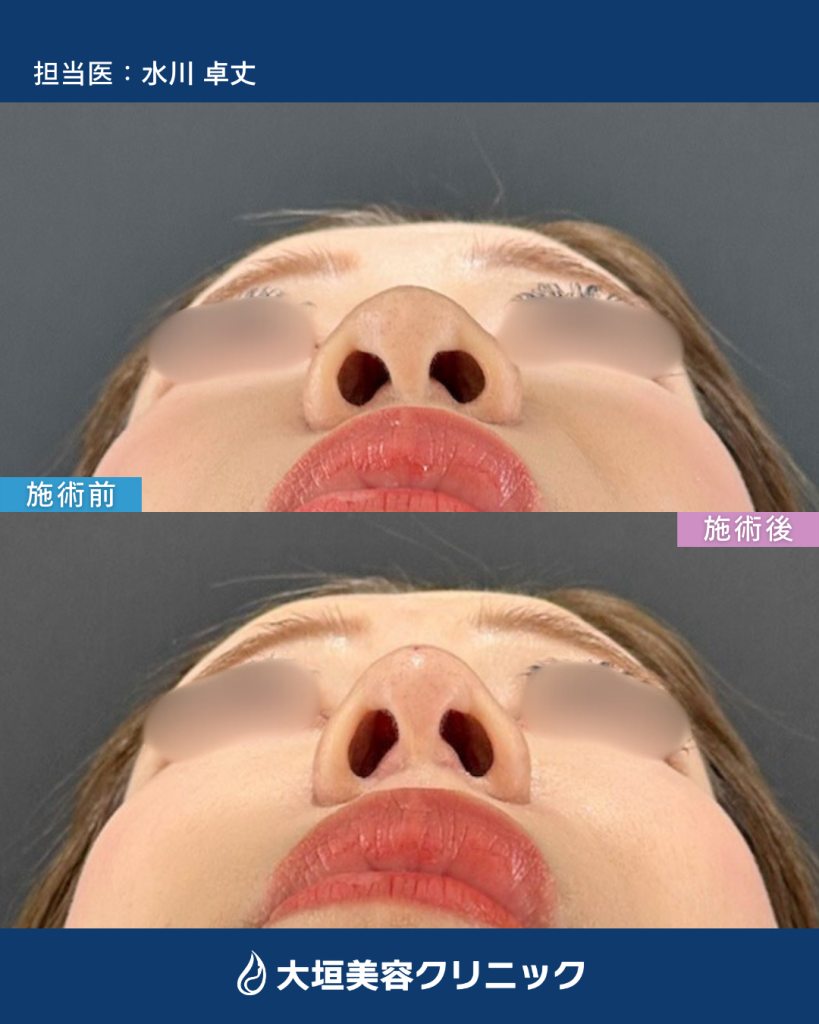 鼻ヒアルロン酸③