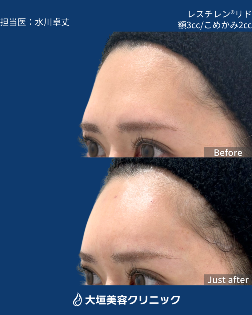 額・こめかみヒアルロン酸 ①