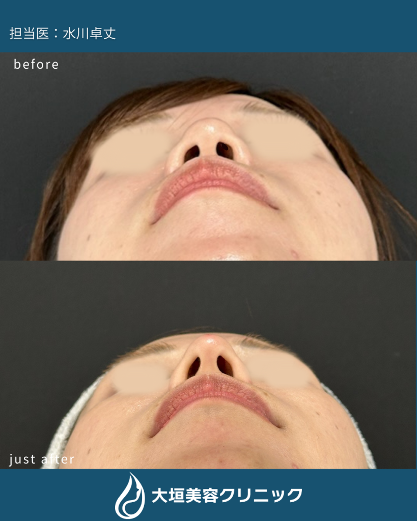 鼻ヒアルロン酸④