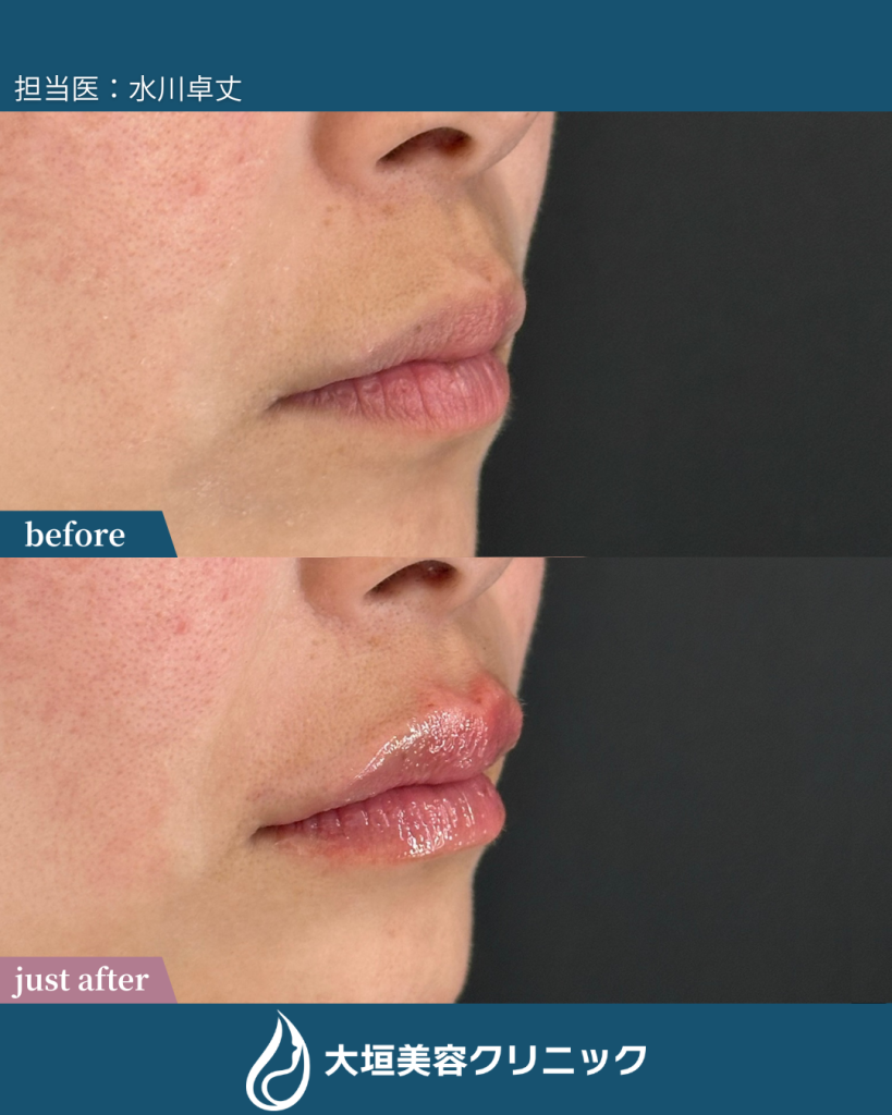 唇ヒアルロン酸 ①