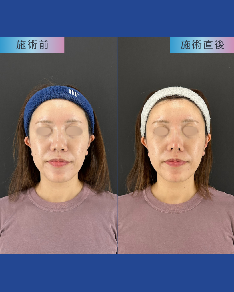 鼻・顎ヒアルロン酸③