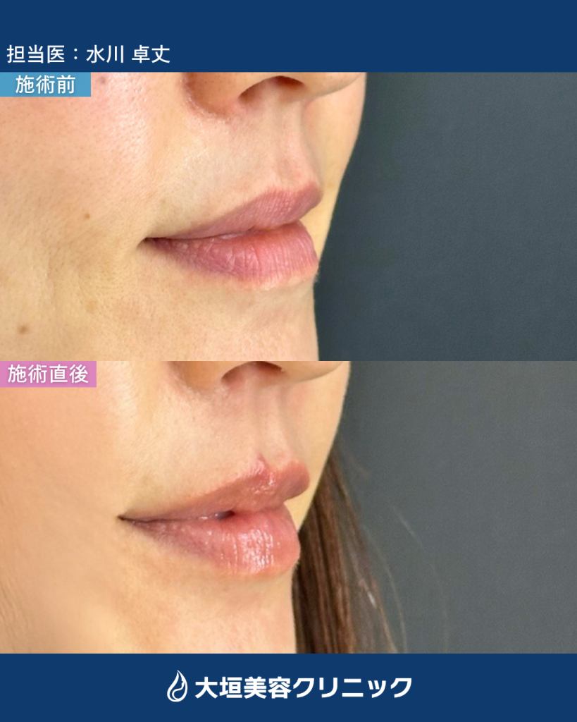 唇ヒアルロン酸③